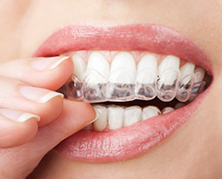 Invisalign2.jpg